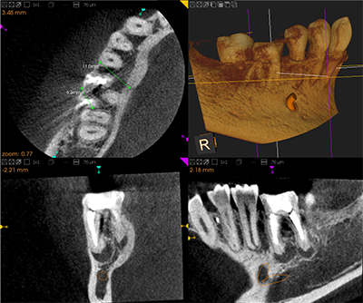 ３次元歯科用ＣＴ