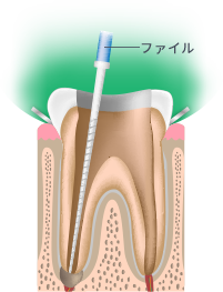 根管治療Step.3 根管の長さを測定