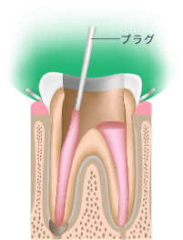 根管治療Step.4 充填剤で密封