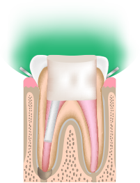 根管治療Step.5 土台のコアを入れる