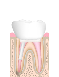 根管治療Step.6 被せ物を装着